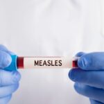 Measles Surge Across North America Prompts Urgent Regional Health Alert