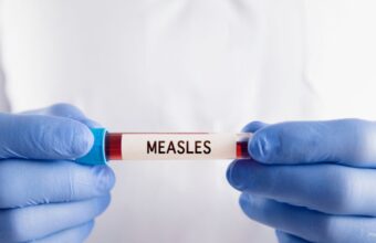 Measles Surge Across North America Prompts Urgent Regional Health Alert