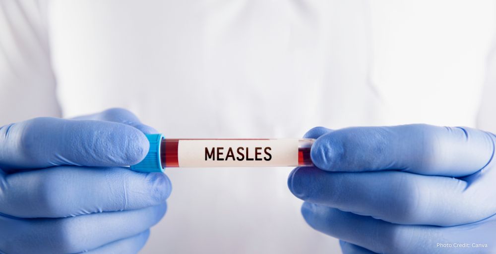 Measles Surge Across North America Prompts Urgent Regional Health Alert