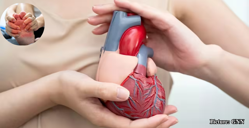 GNN Gout Medications Linked to Decreased Risk of Heart Attack and Stroke Study Finds