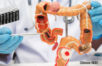 GNN Study Reveals Aspirin's Potential in Reducing Colorectal Cancer Recurrence