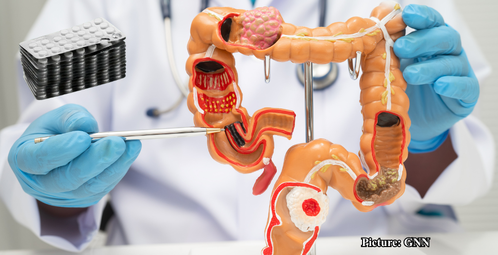 GNN Study Reveals Aspirin's Potential in Reducing Colorectal Cancer Recurrence