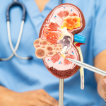 GNN The Importance of Morning Water Consumption for Kidney Health