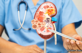 GNN The Importance of Morning Water Consumption for Kidney Health