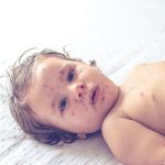 Photo South Carolina Declares End to Decades Largest Measles Outbreak Amid National Surge