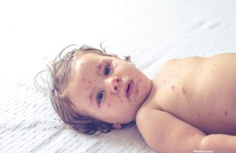 Photo South Carolina Declares End to Decades Largest Measles Outbreak Amid National Surge