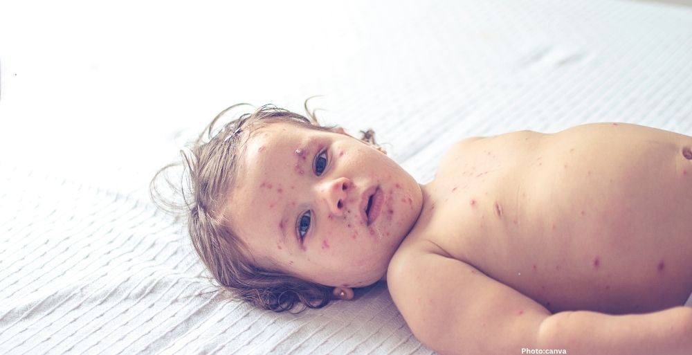Photo South Carolina Declares End to Decades Largest Measles Outbreak Amid National Surge