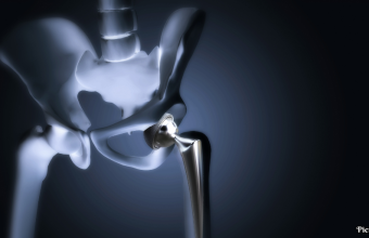 GNN Surge in Hip Replacement Surgeries Among Younger Indians Attributed to Post COVID Complications