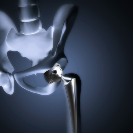 GNN Surge in Hip Replacement Surgeries Among Younger Indians Attributed to Post COVID Complications