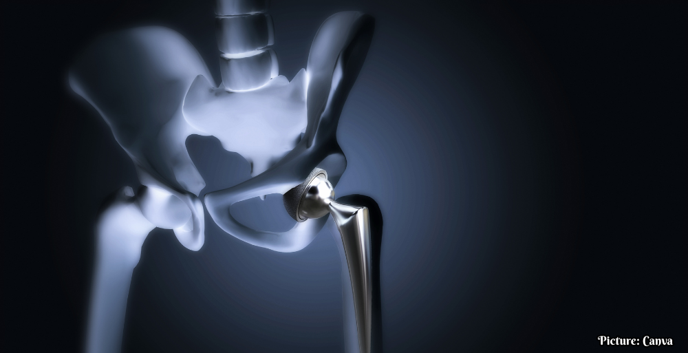 GNN Surge in Hip Replacement Surgeries Among Younger Indians Attributed to Post COVID Complications