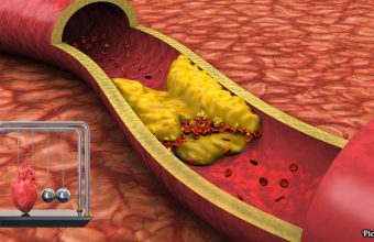 GNN National Medical Organizations Issue Stricter Cholesterol Guidelines Lowering LDL Targets for Cardiovascular Prevention