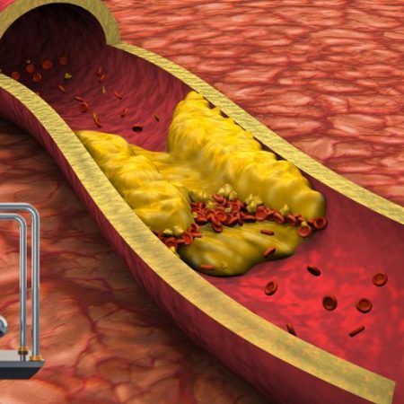 GNN National Medical Organizations Issue Stricter Cholesterol Guidelines Lowering LDL Targets for Cardiovascular Prevention