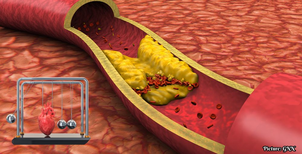 GNN National Medical Organizations Issue Stricter Cholesterol Guidelines Lowering LDL Targets for Cardiovascular Prevention
