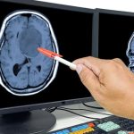 Promising New Treatment for Glioblastoma Shows Early Encouraging Results