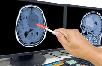 Promising New Treatment for Glioblastoma Shows Early Encouraging Results