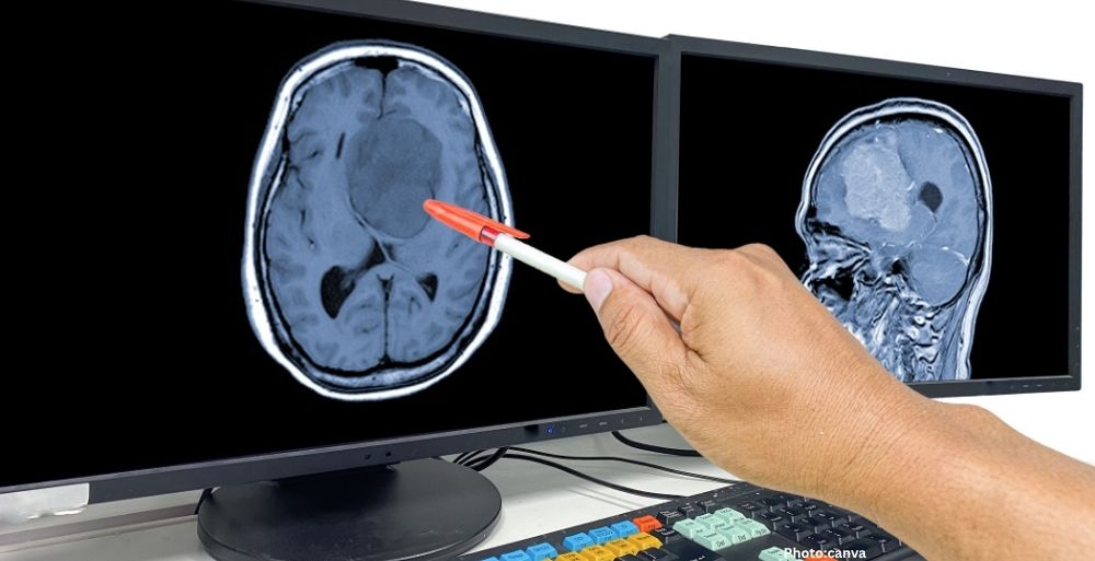 Promising New Treatment for Glioblastoma Shows Early Encouraging Results