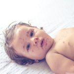United States Faces Surge in Measles Cases Threatening Elimination Status