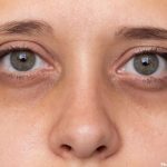 Effective Strategies to Minimize Dark Circles Under the Eyes