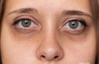 Effective Strategies to Minimize Dark Circles Under the Eyes