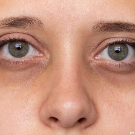 Effective Strategies to Minimize Dark Circles Under the Eyes