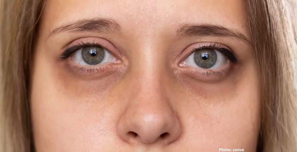 Effective Strategies to Minimize Dark Circles Under the Eyes