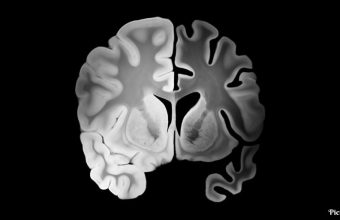 GNN King's College London Study Links Long Term Inflammation to Cognitive Decline