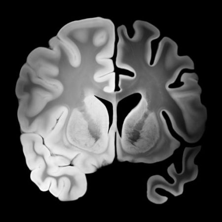 GNN King's College London Study Links Long Term Inflammation to Cognitive Decline