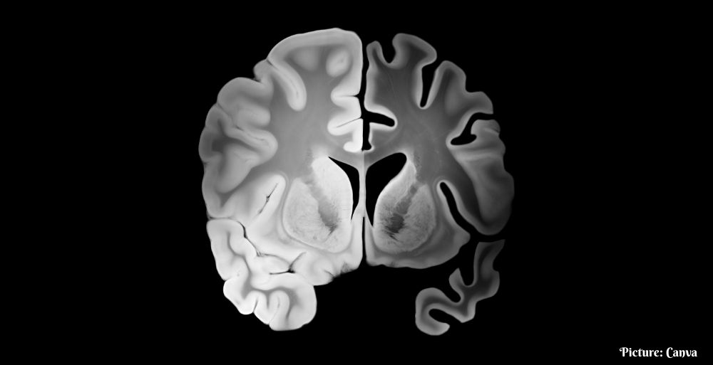 GNN King's College London Study Links Long Term Inflammation to Cognitive Decline