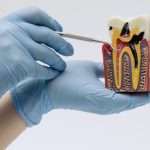 Study Reveals Silver Diamine Fluoride as Effective Cavity Treatment for Young Children GNN Study Reveals Silver Diamine Fluoride as Effective Cavity Treatment for Young Children