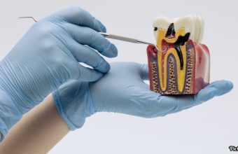 GNN Study Reveals Silver Diamine Fluoride as Effective Cavity Treatment for Young Children