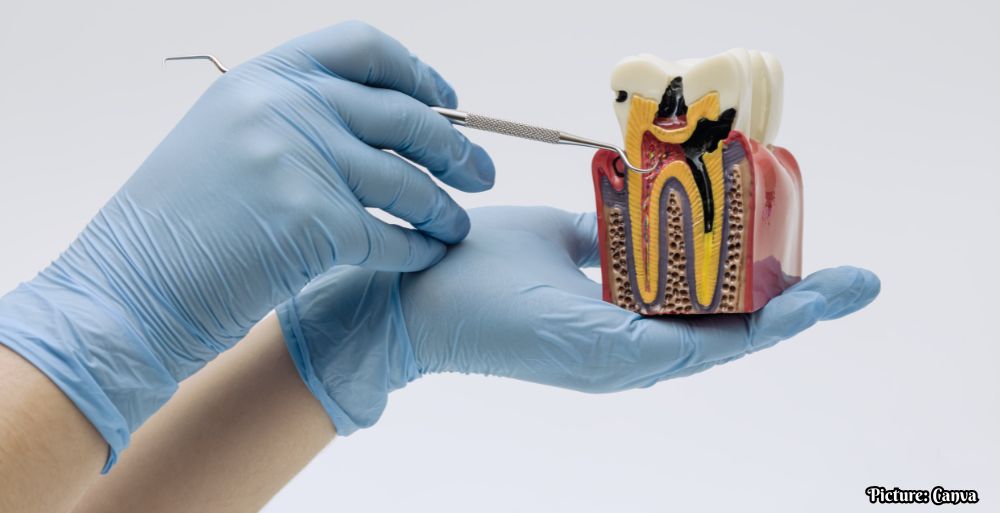 GNN Study Reveals Silver Diamine Fluoride as Effective Cavity Treatment for Young Children