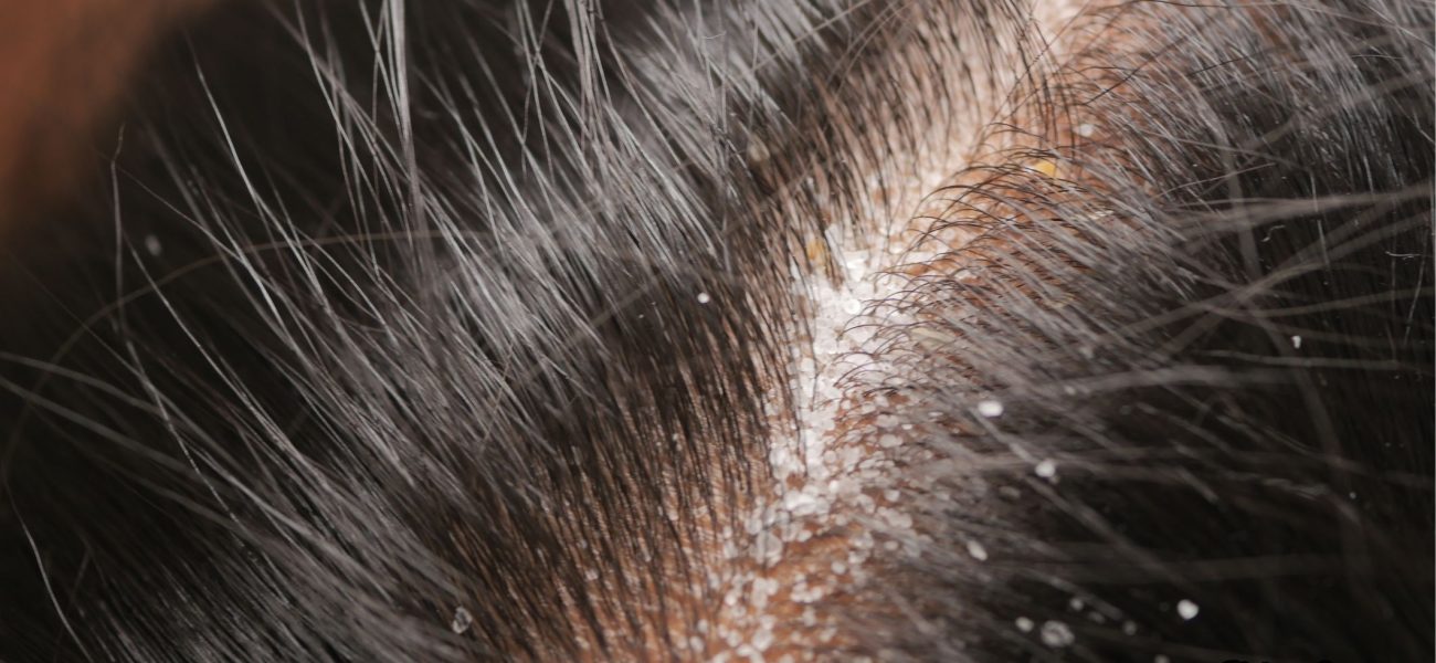 GNN Understanding Hair and Scalp Health