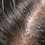 GNN Understanding Hair and Scalp Health