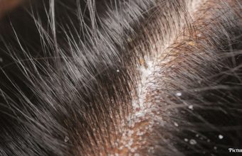 GNN Understanding Hair and Scalp Health