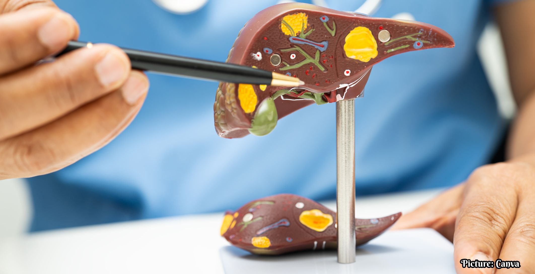 GNN Understanding Cirrhosis