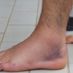 GNN Understanding Swollen Feet and Ankles