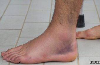 GNN Understanding Swollen Feet and Ankles