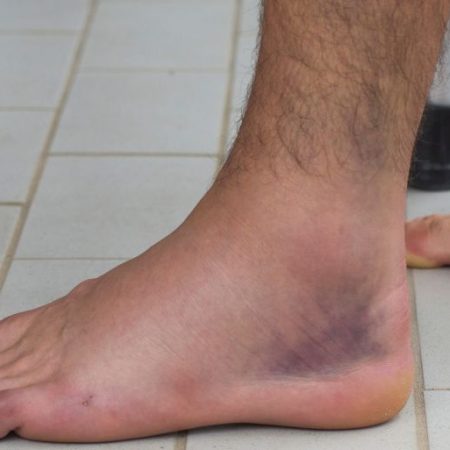 GNN Understanding Swollen Feet and Ankles