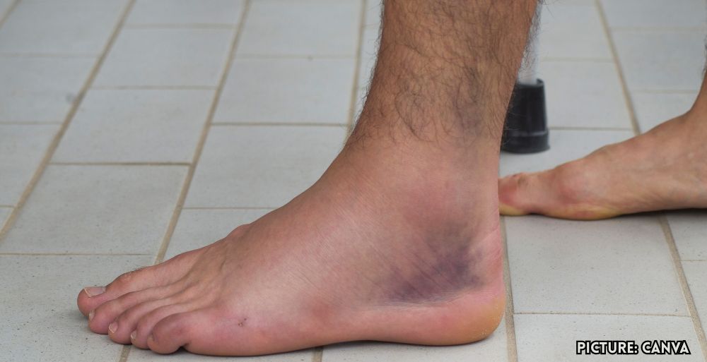 GNN Understanding Swollen Feet and Ankles