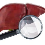 Healthandwellness Cirrhosis Causes Symptoms Diagnosis and Treatment