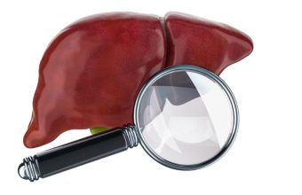 Healthandwellness Cirrhosis Causes Symptoms Diagnosis and Treatment